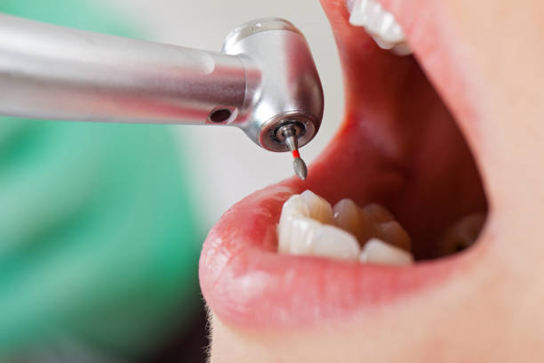 Best Urgent Care for Lost Fillings or Crowns in Wahpeton, ND